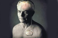 【健康解碼】起搏器真的能治好帕金森病嗎？